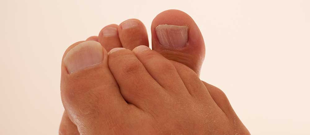 Nagelpilz Onychomykose Tinea unguium Nagelpilz auch Onychomykose oder Tinea unguium genannt